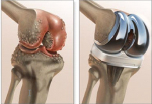 artroplastica